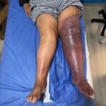 Infección en las piernas: señales que no deben confundirse con “mala circulación”